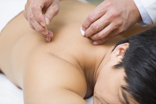 acupuncture contre le stress